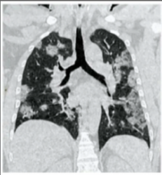 Lung-scan-e1583.png